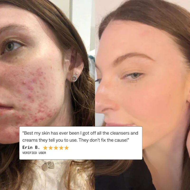 my way up Complete Skin Clear System