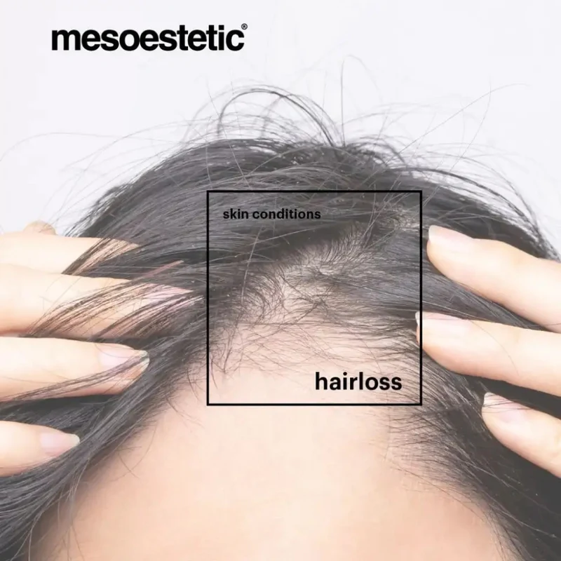 Mesoestetic Hair Care Tricology Intensive Hair Loss Shampoo 225ml
