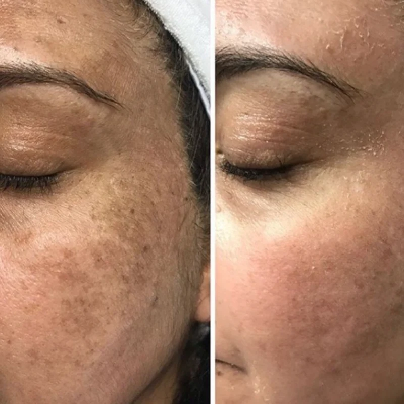 Mesoestetic Cosmelan 2 Depigmenting Treatment 30g
