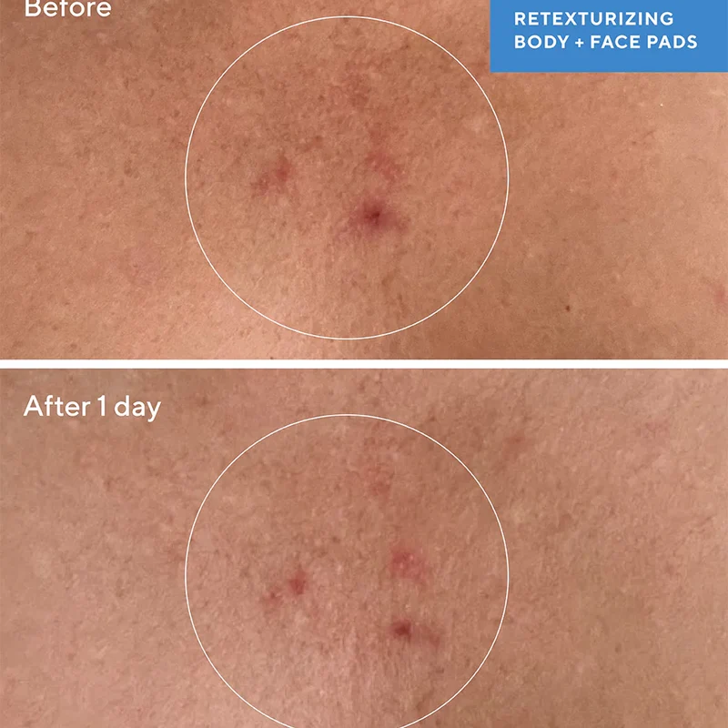 Murad Blemish Control Retexturizing Body Pads (45pcs)